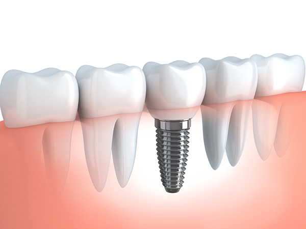 Dental-Implants