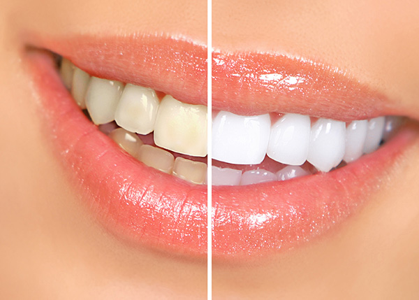 Tooth-Whitening